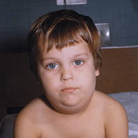 Child with swollen cheeks and face from mumps